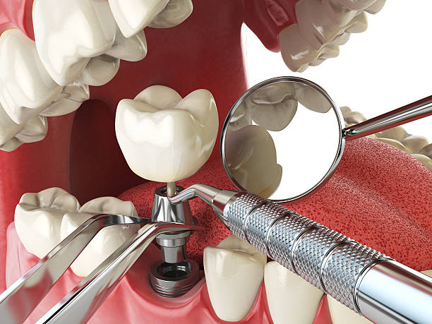 Best Emergency Dental Care for Broken or Chipped Teeth in Silver City, NM